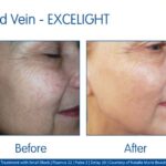 Facial Add On - Ipl Skin Rejuvenation 15 mins
