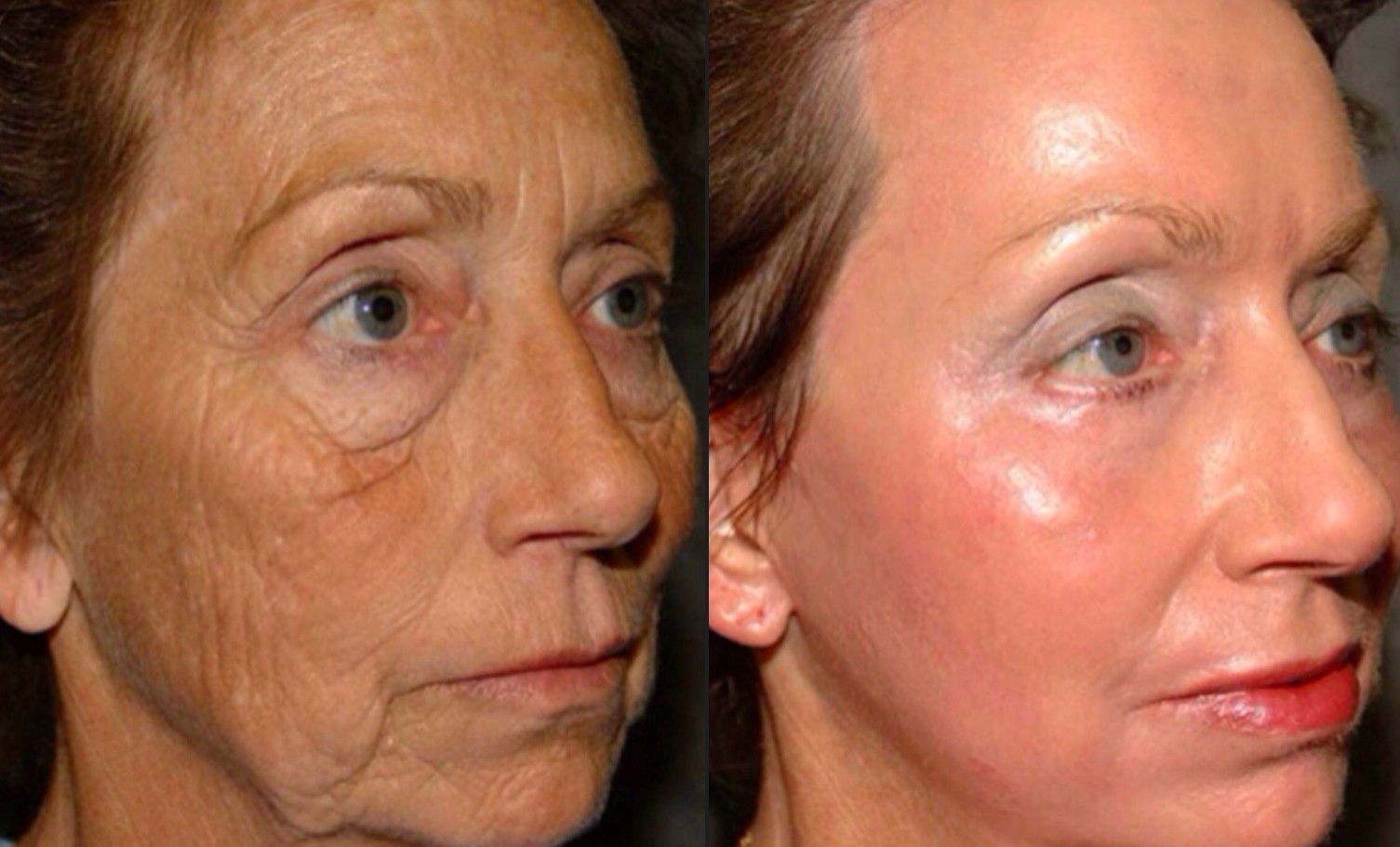 RESURFACE, PEEL, AND HEAL 75 min